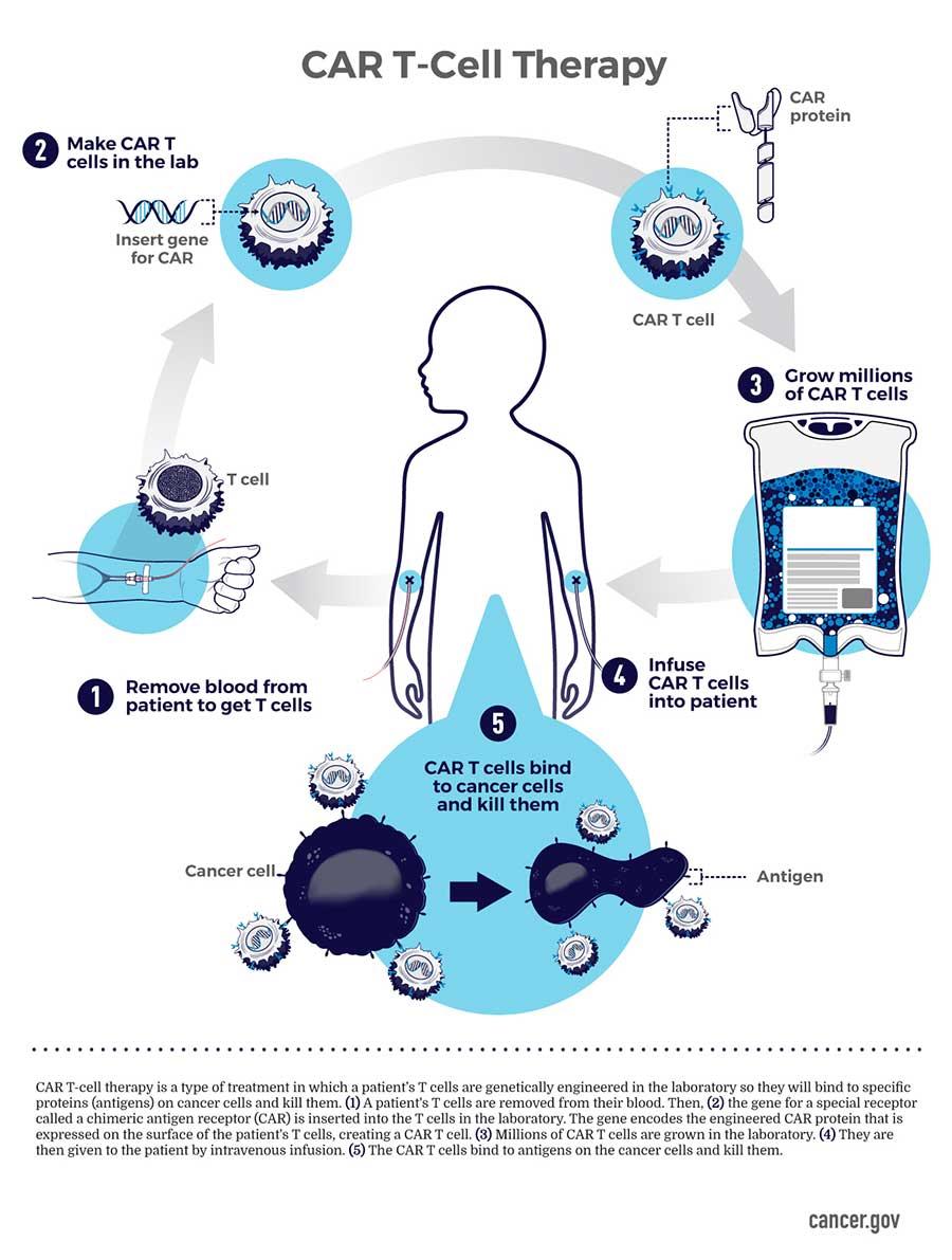 Liệu pháp CAR-T Chimeric Antigen Receptor T-cell Therapy phương pháp điều trị ung thư tiên tiến